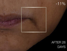 Nahaufnahme der Haut vor der Behandlung, zeigt sichtbare Nasolabialfalten und Zeichen der Alterung um den Mund herum.